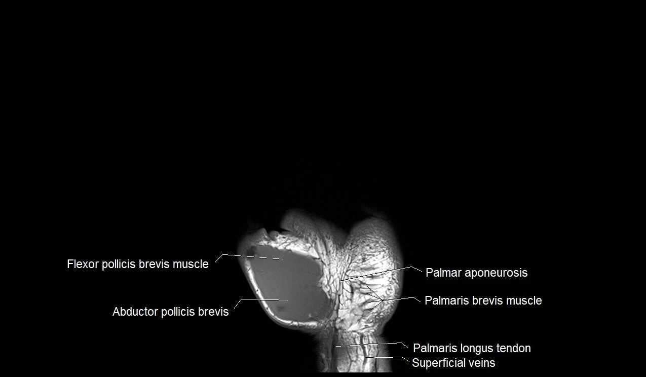 MRI 3T coronal hand cross sectional anatomy image 3.webp